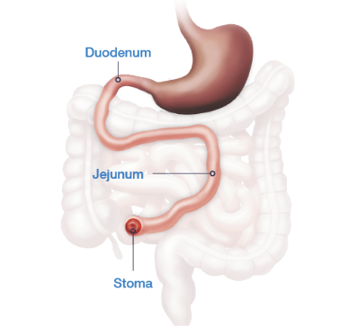 End-jejunostomy with no colon in continuity