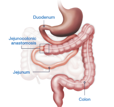 Jejunocolic anastomosis with no ileo-cecal valve and a part of the colon in continuity