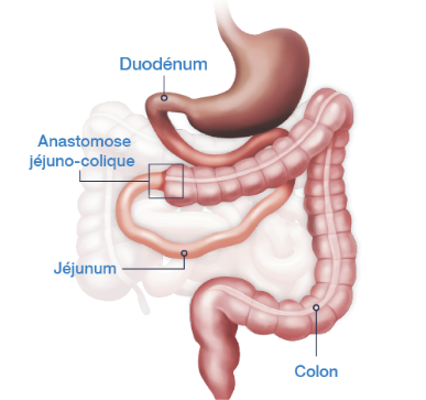 Anastomose jéjuno-colique sans valvule iléo-cæcale et une partie du colon en continuité