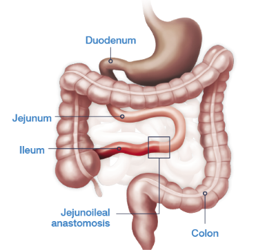 Jejunoileal anastomosis with both the ileo-cecal valve and the entire colon in continuity